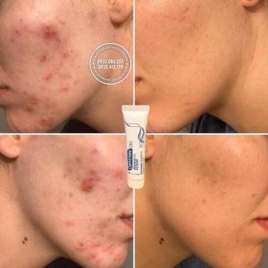 kem-tri-mun-differin-gel-acne-treatment-0-1-tuyp-15g5